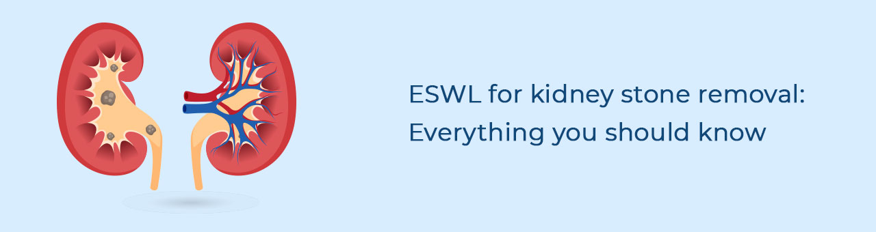 ESWL for Kidney Stone Removal: Everything you should know