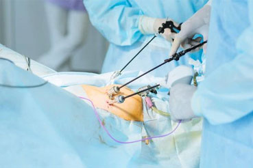 Laparoscopic Cholecystectomy Surgery- A solution for gallstones