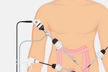 Is Laparoscopic Appendectomy an Emergency Surgery?
