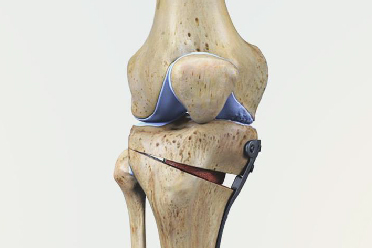 Joint Preservation: How to avoid and delay joint replacement