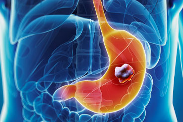 All You Should Know About Gastric Cancer