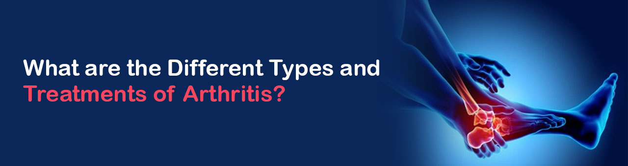 What are the Different Types and Treatments of Arthritis? 
