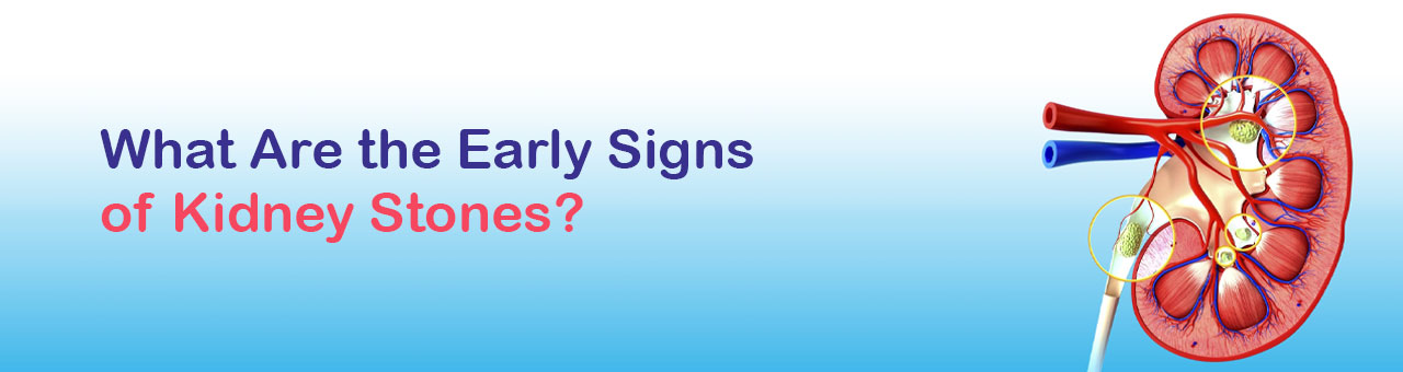 What Are the Early Signs of Kidney Stones?